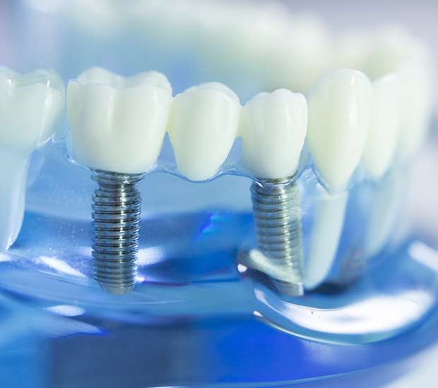 Brea Dental Implants